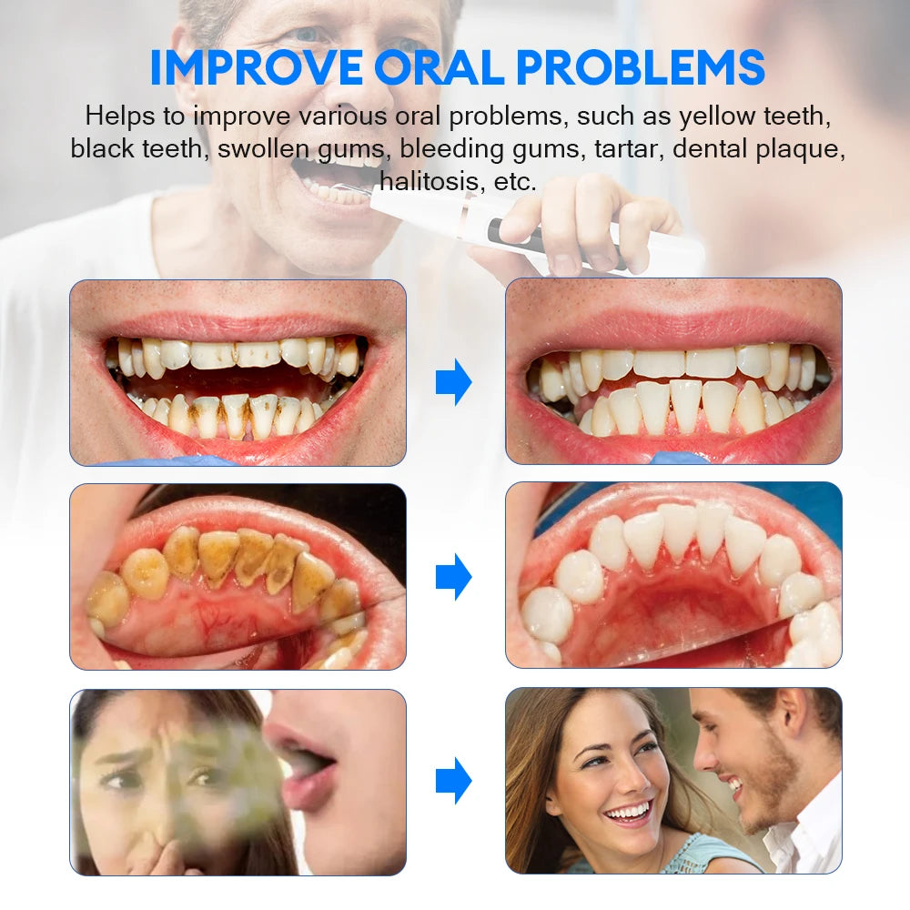 Ultrasonic Electric Teeth Cleaner – Tartar & Plaque Remover