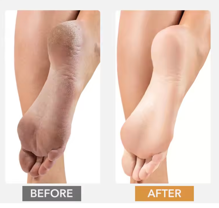 Electric Callus Remover & Foot File – Professional Pedicure Kit