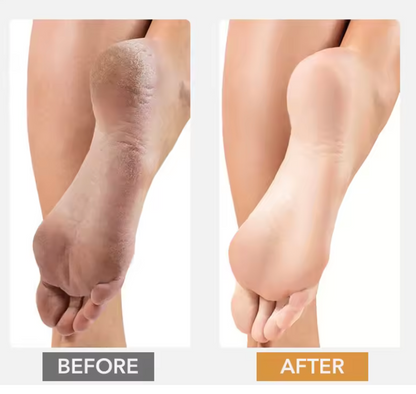 Electric Callus Remover & Foot File – Professional Pedicure Kit